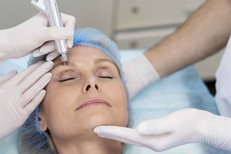Blépharoplastie en Tunisie — chirurgie des paupières