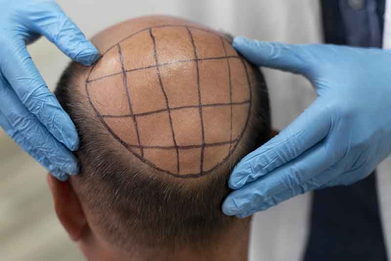 Greffe de cheveux en Tunisie — technique FUE et DHI