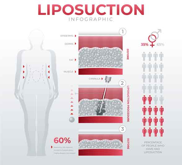 Liposuccion Vaser en Tunisie — affiner la silhouette