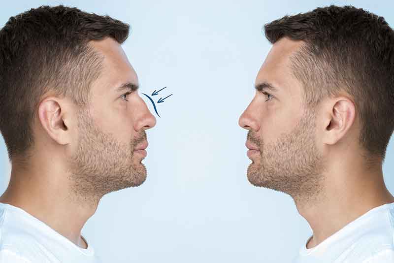 Rhinoplastie en Tunisie — remodelage du nez